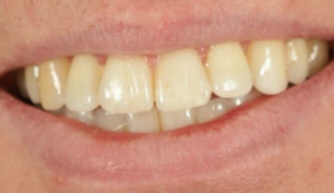After - Leysroad Dental