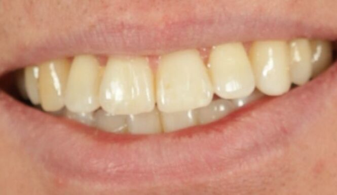 After - Leysroad Dental