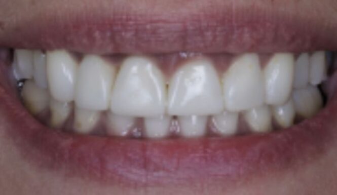 After - Leysroad Dental
