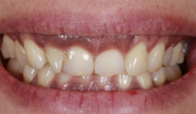 Before close up mouth