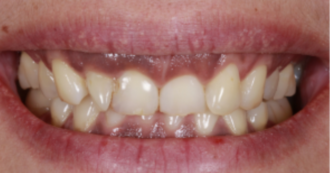 Before close up mouth