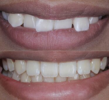 After close up mouthBefore close up mouth