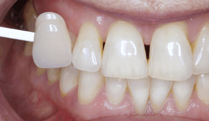 After - Leysroad Dental