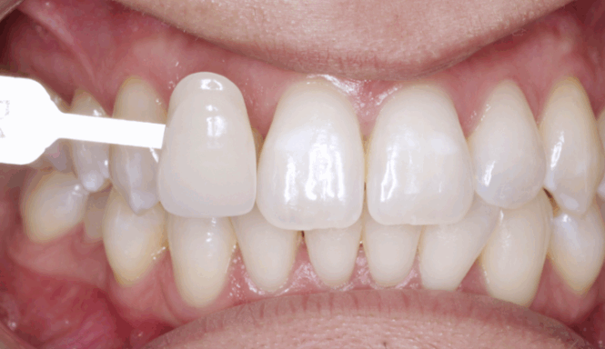 After - Leysroad Dental