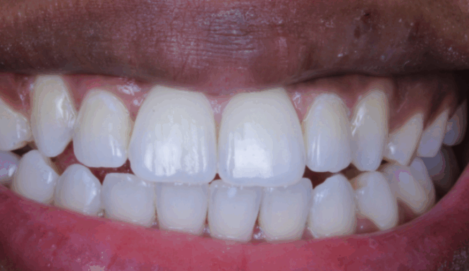 After - Leysroad Dental