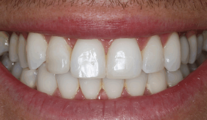 After - Leysroad Dental