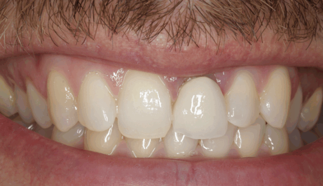 After - Leysroad Dental