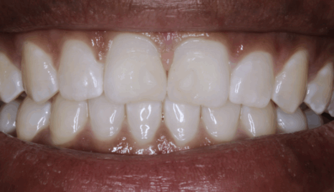 After - Leysroad Dental