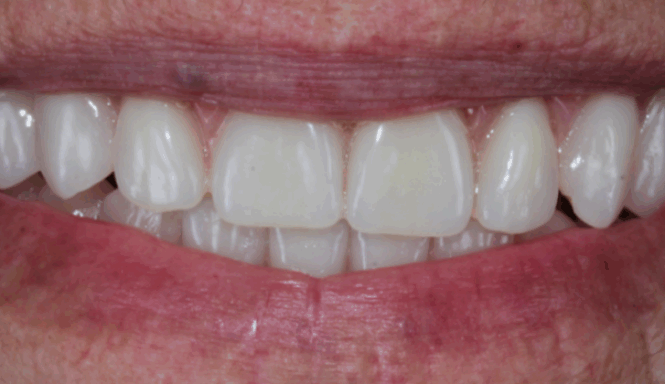 After - Leysroad Dental