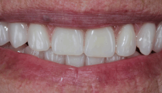 After - Leysroad Dental